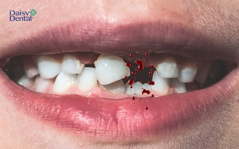 Khi bạn mơ thấy bị rụng răng, đây có thể là dấu hiệu cho thấy bạn đang gặp phải một số vấn đề trong cuộc sống